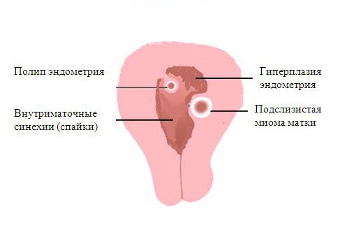 гиперплазия и полипы