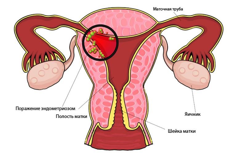 картина эндометриоза в матке