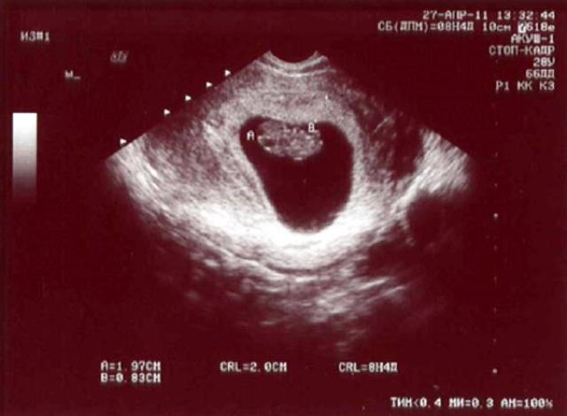 8 9 недель беременности фото как выглядит плод
