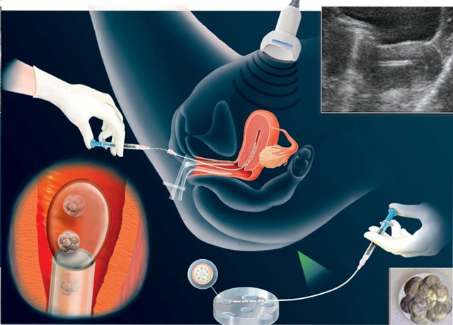 процесс переноса эмбриона в маточную полость