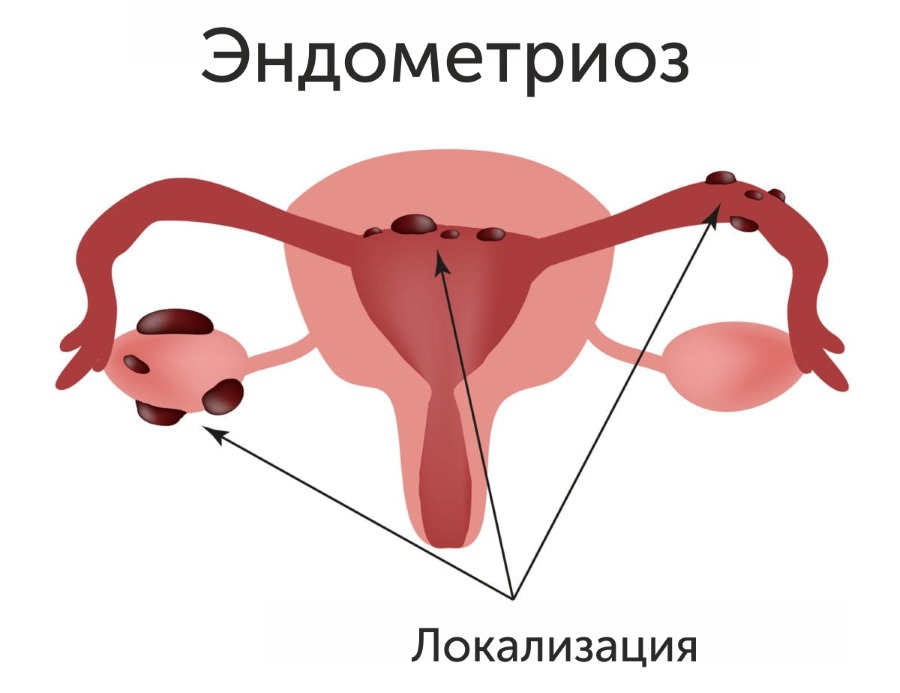локализация эндометриоза